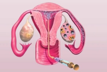 IUI