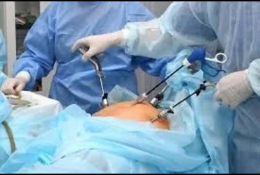 LAPAROSCOPY