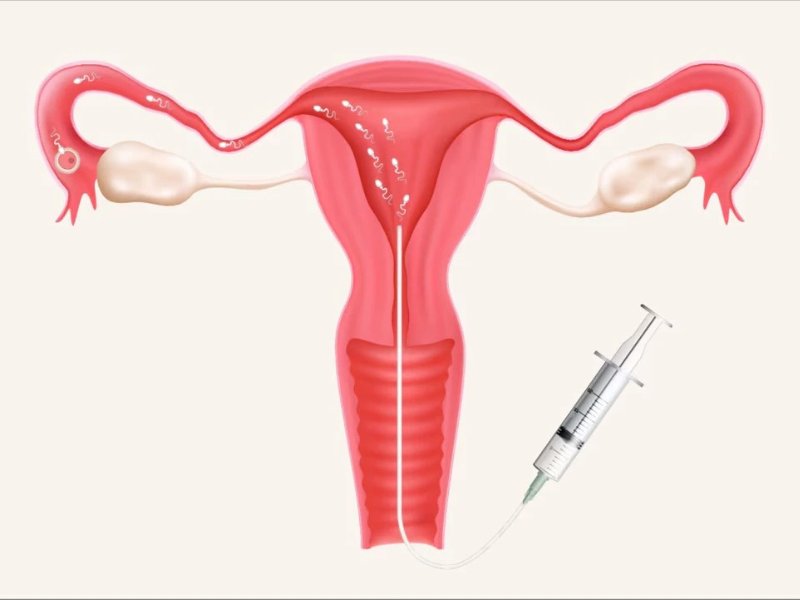 IUI