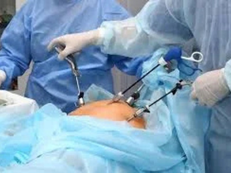 Laparoscopy