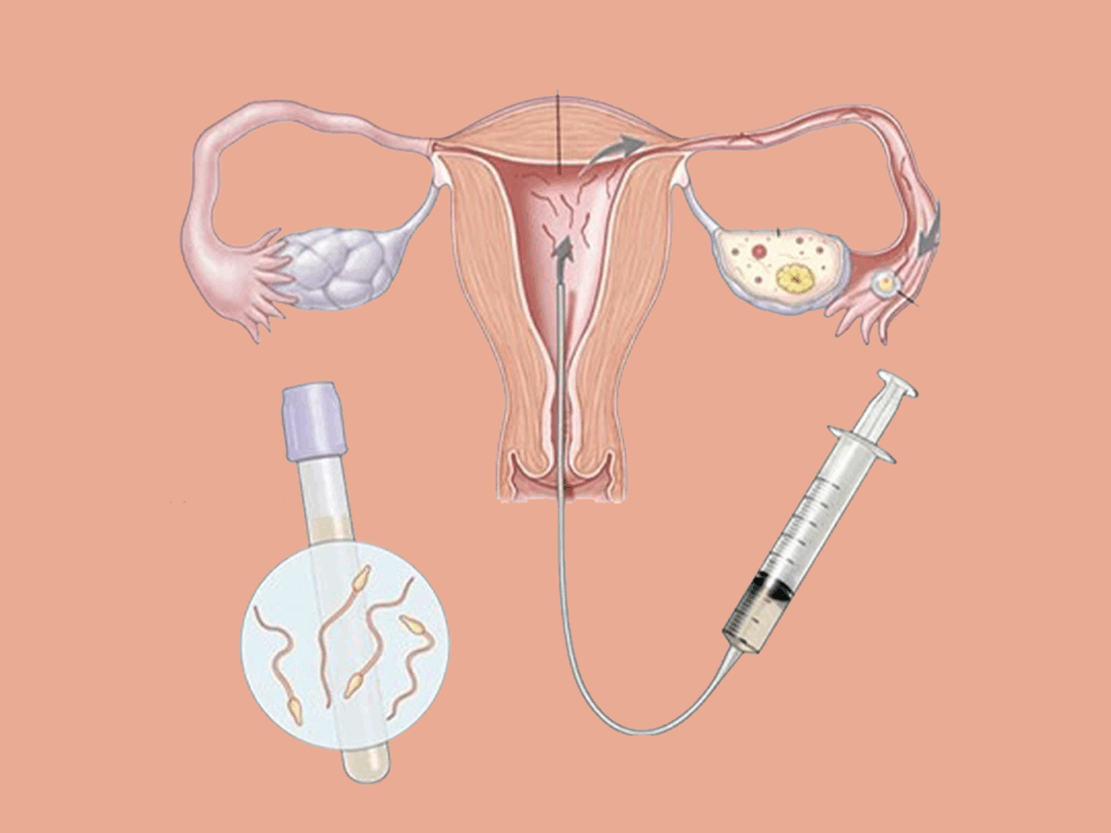iui_img